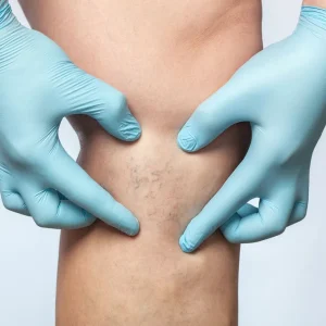 Sclerotherapy Sclerotherapy